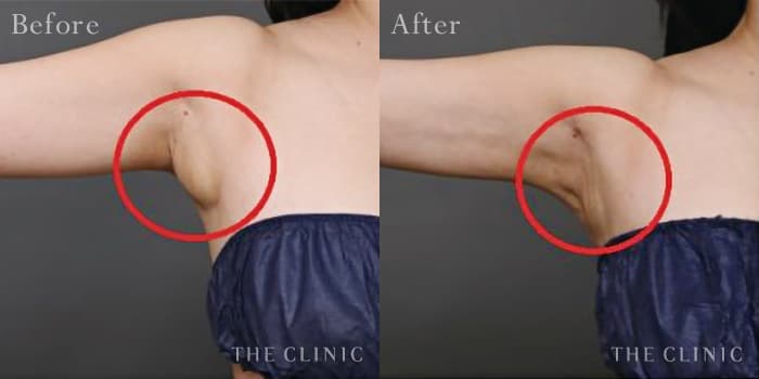 CASE.02 副乳除去 Before/After