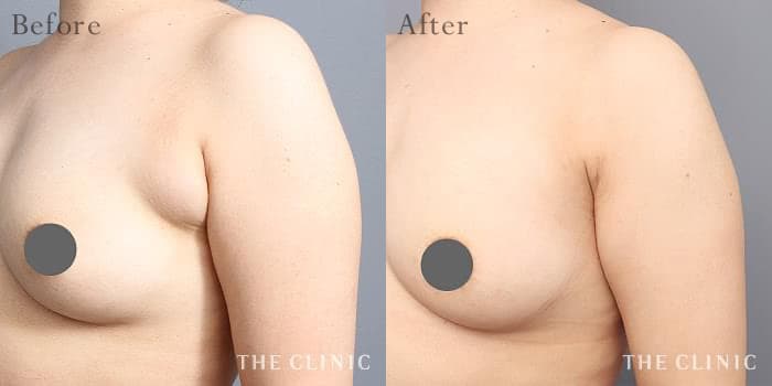 CASE.04 副乳除去 Before/After