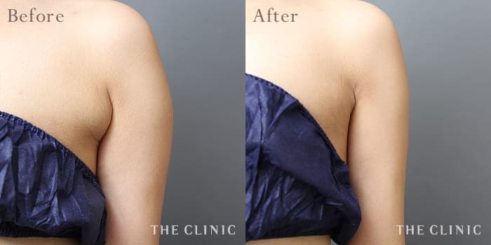 CASE.05 副乳除去 Before/After