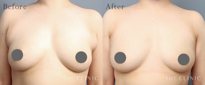 CASE.06 副乳除去 Before/After