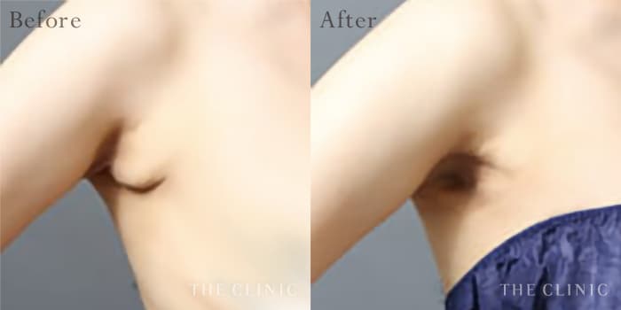 副乳除去の症例 Before/After