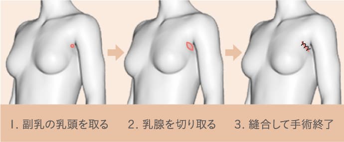 乳腺切除の手順 - 1.副乳の乳頭を取る 2.乳腺を切り取る 3.縫合して手術終了